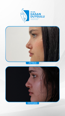 Foto Face Aesthetics Turkey | Hasan Duygulu MD