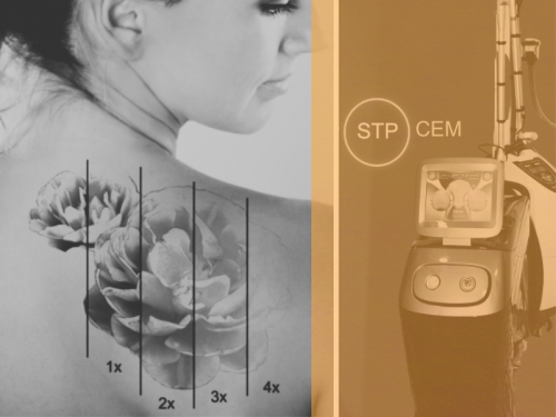Eliminar tatuajes con l�ser en vilanova