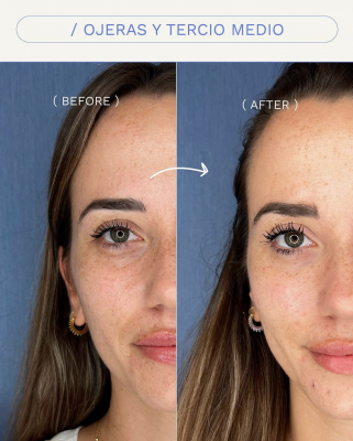 Arrugas de expresi�n