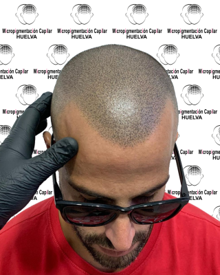 Micropigmentaci�n Capilar Huelva