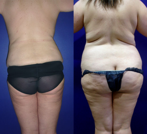 Lipoescultura  Antes y Despu�s
