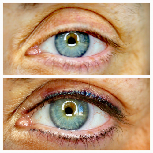 Ojos micropigmentaci�n.