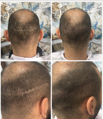 Cicatriz de transplante capilar.