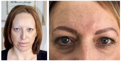 Enfermedades autoinmunes. Lupus.