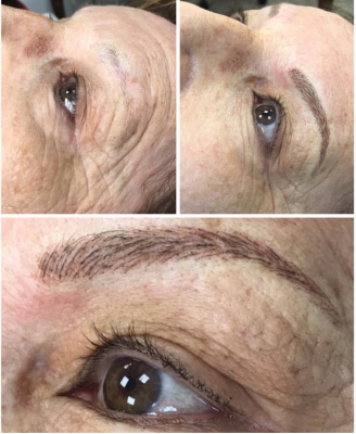 Alopecia cejas