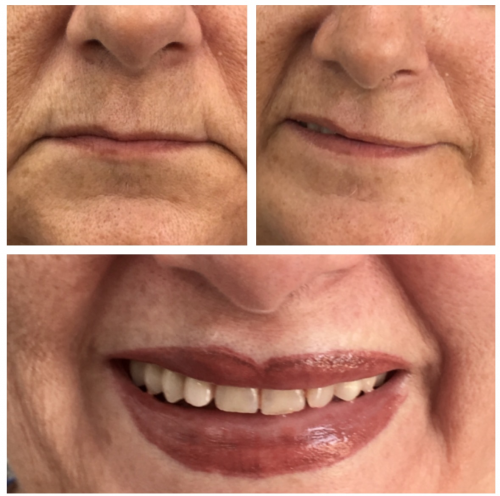 Par�lisis facial labios.