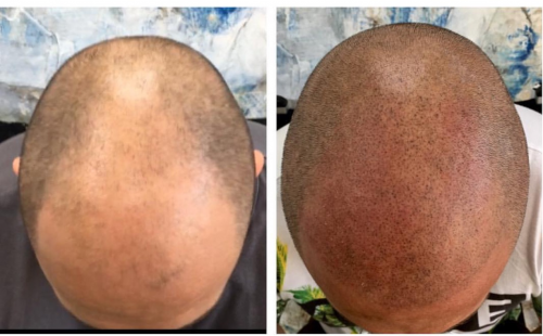 Micropigmentaci�n Capilar