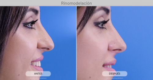 RINOMODELACI�N