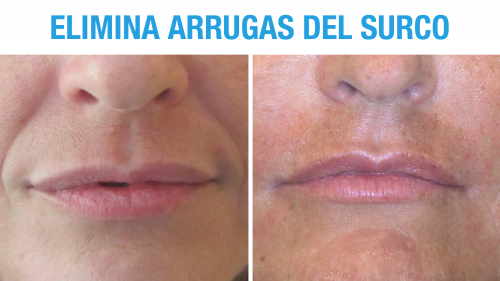 Relleno con �cido Hialur�nico