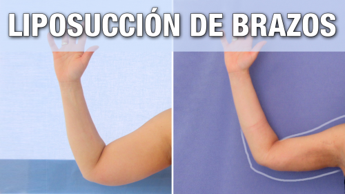 Liposucci�n de Brazos