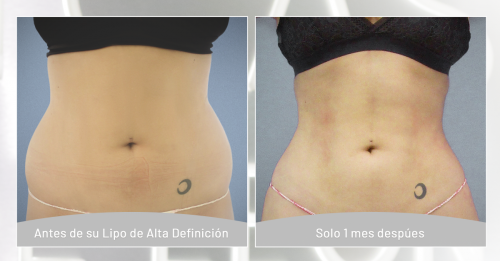Liposucci�n de Alta definici�n