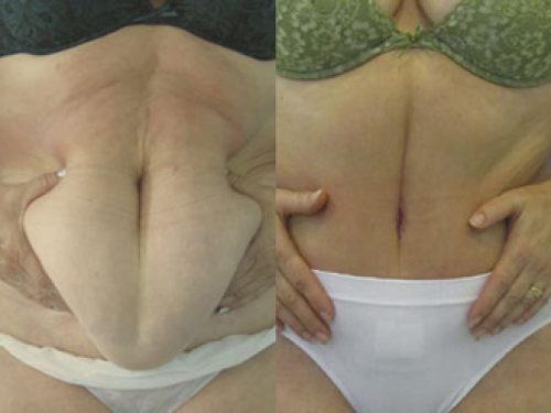 Abdominoplastia