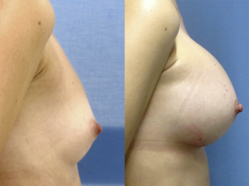 Aumento de Pecho