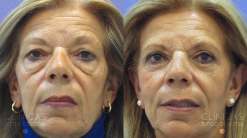 Blefaroplastia