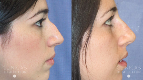 Correcci�n de nariz sin cirug�a