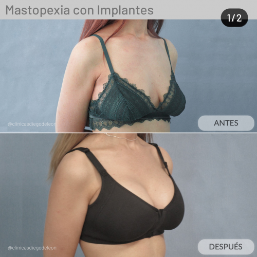 MASTOPEXIA