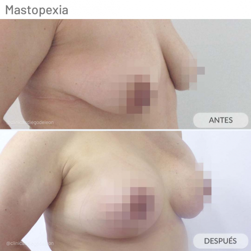 MASTOPEXIA