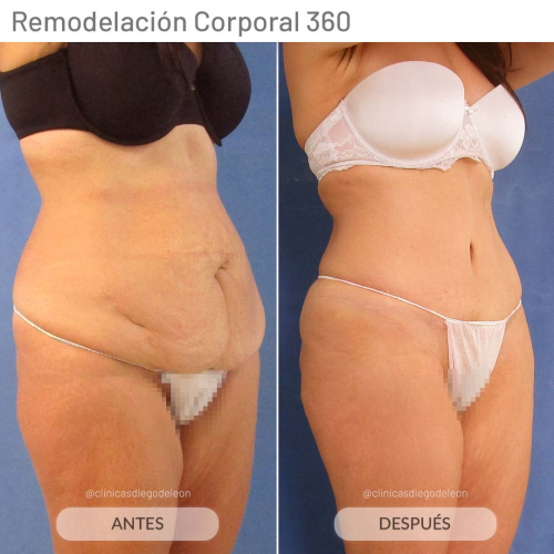 ABDOMINOPLASTIA