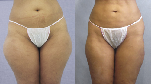 Lipo L�ser Cartucheras