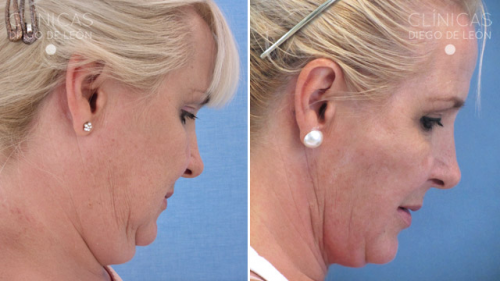 Liposucci�n de Papada