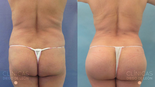 Lipotransferencia a Gl�teos