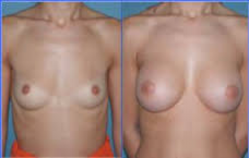 Antes y despu�s mamoplastia