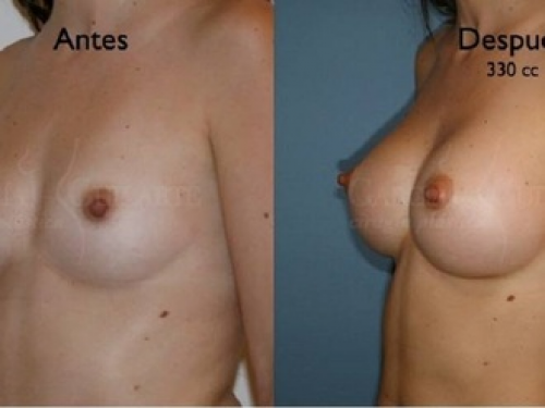 Antes y despu�s aumento de senos