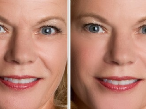 Antes y despu�ss botox