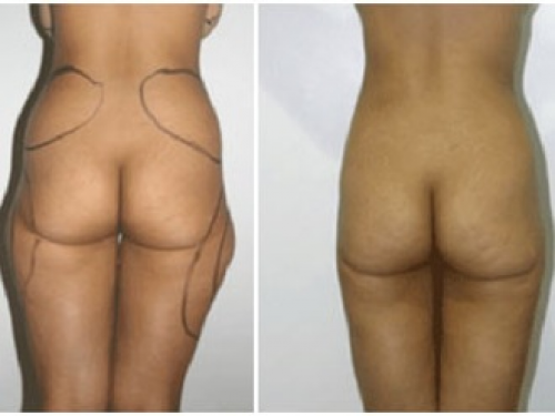 Antes y despu�s liposucci�n