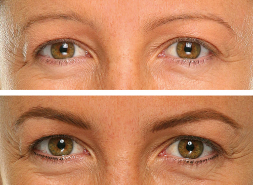 Antes y despu�s micropigmentaci�n cejas