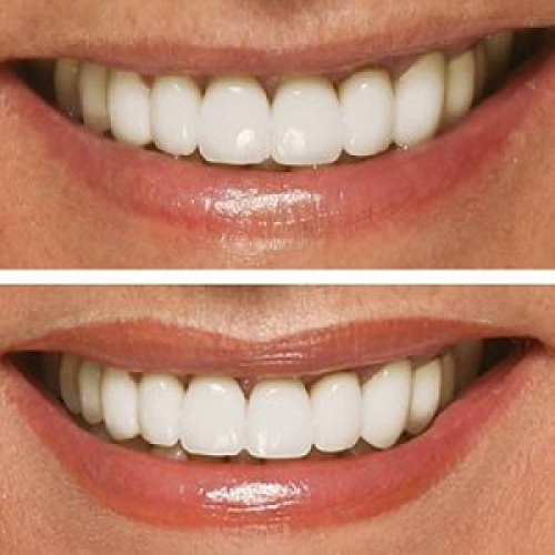 Antes y despues Micropigmantaci�n Labios