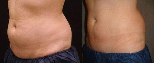 Criolipolisis