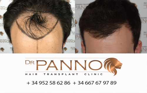 Foto Cl�nica de Trasplante Capilar Dr. Panno