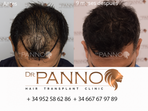 Foto Cl�nica de Trasplante Capilar Dr. Panno