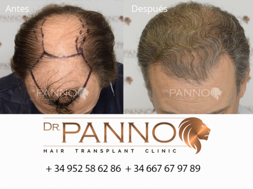 Foto Cl�nica de Trasplante Capilar Dr. Panno