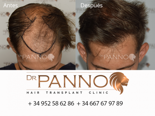 Foto Cl�nica de Trasplante Capilar Dr. Panno