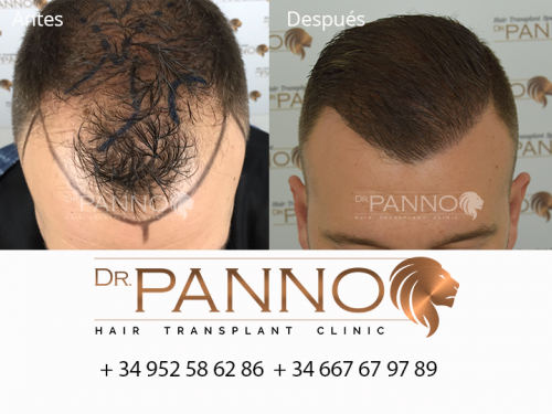 Foto Cl�nica de Trasplante Capilar Dr. Panno