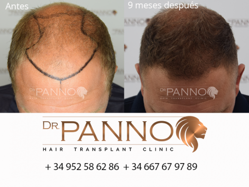 Foto Cl�nica de Trasplante Capilar Dr. Panno