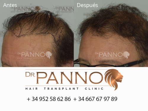 Foto Cl�nica de Trasplante Capilar Dr. Panno