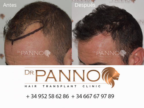 Foto Cl�nica de Trasplante Capilar Dr. Panno