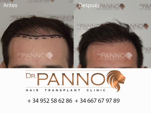 Foto Cl�nica de Trasplante Capilar Dr. Panno
