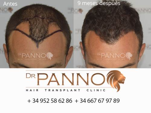 Foto Cl�nica de Trasplante Capilar Dr. Panno