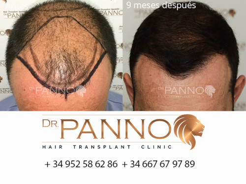 Foto Cl�nica de Trasplante Capilar Dr. Panno