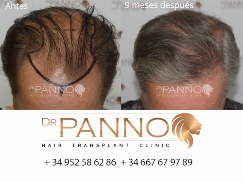 Foto Cl�nica de Trasplante Capilar Dr. Panno