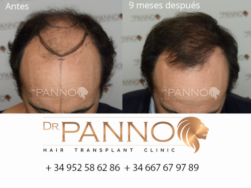 Foto Cl�nica de Trasplante Capilar Dr. Panno