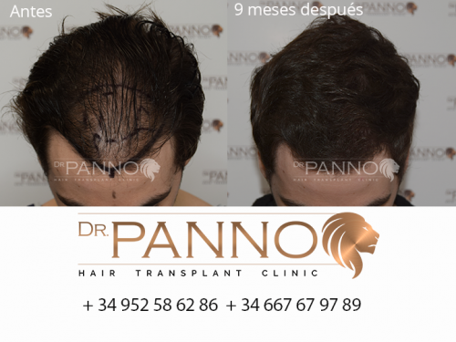 Foto Cl�nica de Trasplante Capilar Dr. Panno