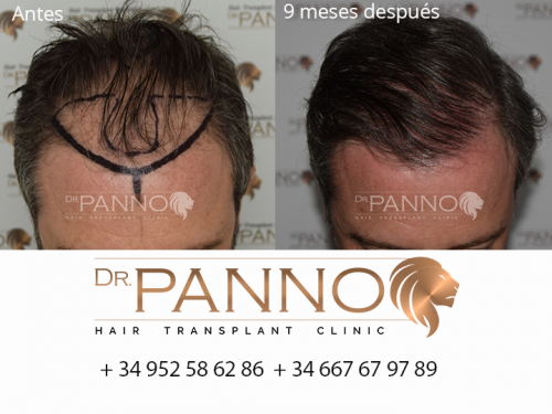 Foto Cl�nica de Trasplante Capilar Dr. Panno