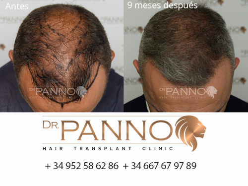 Foto Cl�nica de Trasplante Capilar Dr. Panno