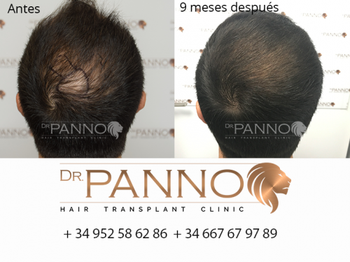 Foto Cl�nica de Trasplante Capilar Dr. Panno
