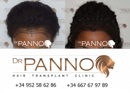 Foto Cl�nica de Trasplante Capilar Dr. Panno